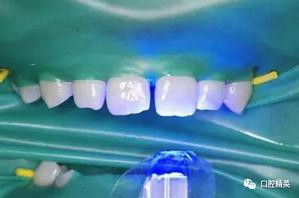 圖解:前牙間隙關閉過程 圖解:前牙間隙關閉過程