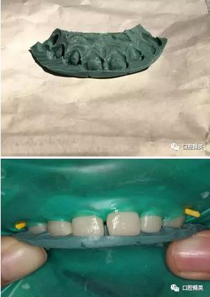 圖解:前牙間隙關閉過程 圖解:前牙間隙關閉過程