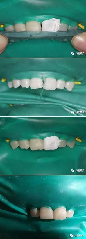 圖解:前牙間隙關閉過程 圖解:前牙間隙關閉過程