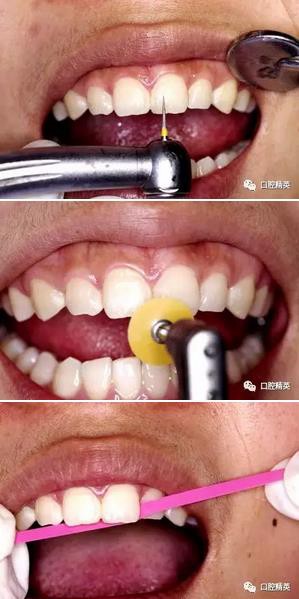 圖解:前牙間隙關閉過程 圖解:前牙間隙關閉過程