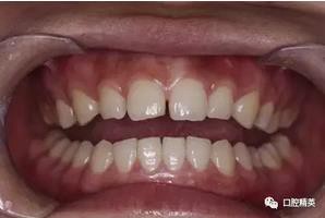 圖解:前牙間隙關閉過程 圖解:前牙間隙關閉過程