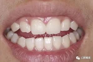 圖解:前牙間隙關閉過程 圖解:前牙間隙關閉過程