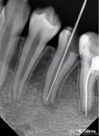 年輕恒牙之根尖誘導(dǎo)術(shù) 年輕恒牙之根尖誘導(dǎo)術(shù)