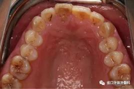 右上前牙即刻種植即刻修復(fù)1例 右上前牙即刻種植即刻修復(fù)1例