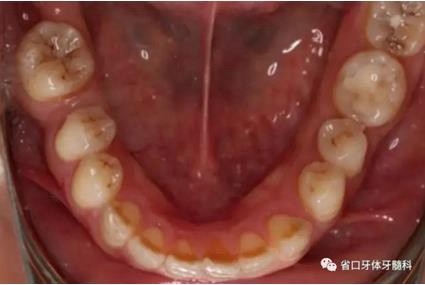 右上前牙即刻種植即刻修復(fù)1例 右上前牙即刻種植即刻修復(fù)1例