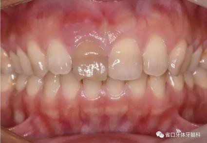 右上前牙即刻種植即刻修復(fù)1例 右上前牙即刻種植即刻修復(fù)1例