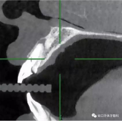 右上前牙即刻種植即刻修復(fù)1例 右上前牙即刻種植即刻修復(fù)1例