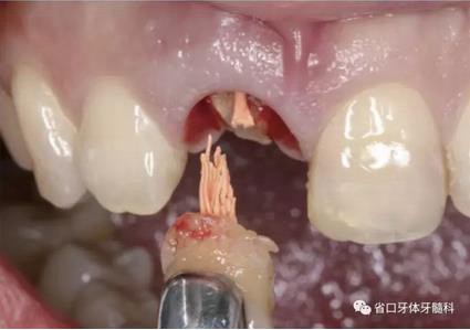 右上前牙即刻種植即刻修復(fù)1例 右上前牙即刻種植即刻修復(fù)1例