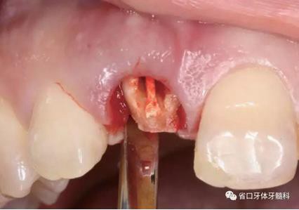 右上前牙即刻種植即刻修復(fù)1例 右上前牙即刻種植即刻修復(fù)1例