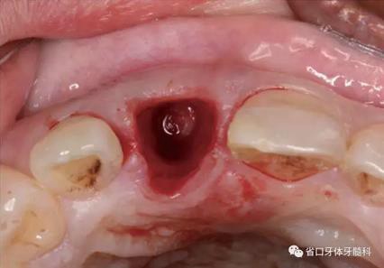 右上前牙即刻種植即刻修復(fù)1例 右上前牙即刻種植即刻修復(fù)1例