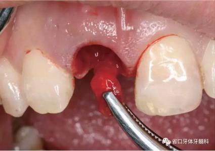 右上前牙即刻種植即刻修復(fù)1例 右上前牙即刻種植即刻修復(fù)1例