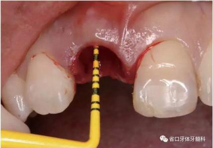 右上前牙即刻種植即刻修復(fù)1例 右上前牙即刻種植即刻修復(fù)1例