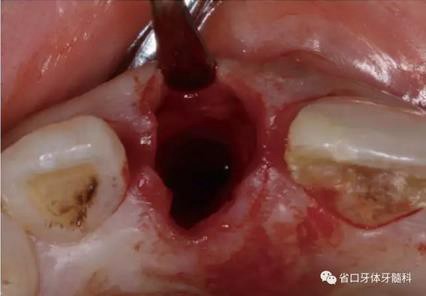 右上前牙即刻種植即刻修復(fù)1例 右上前牙即刻種植即刻修復(fù)1例