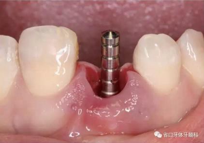 右上前牙即刻種植即刻修復(fù)1例 右上前牙即刻種植即刻修復(fù)1例