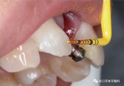 右上前牙即刻種植即刻修復(fù)1例 右上前牙即刻種植即刻修復(fù)1例