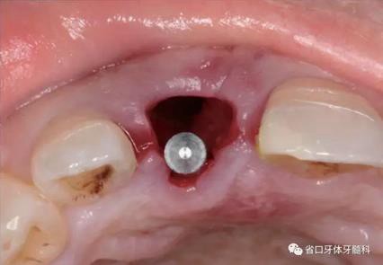 右上前牙即刻種植即刻修復(fù)1例 右上前牙即刻種植即刻修復(fù)1例