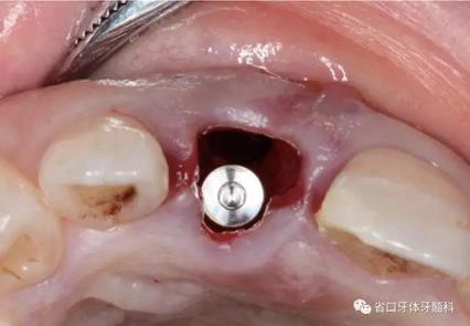 右上前牙即刻種植即刻修復(fù)1例 右上前牙即刻種植即刻修復(fù)1例