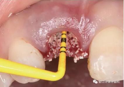 右上前牙即刻種植即刻修復(fù)1例 右上前牙即刻種植即刻修復(fù)1例