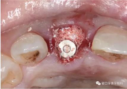 右上前牙即刻種植即刻修復(fù)1例 右上前牙即刻種植即刻修復(fù)1例