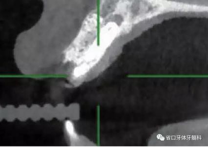 右上前牙即刻種植即刻修復(fù)1例 右上前牙即刻種植即刻修復(fù)1例