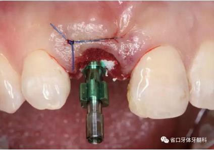 右上前牙即刻種植即刻修復(fù)1例 右上前牙即刻種植即刻修復(fù)1例