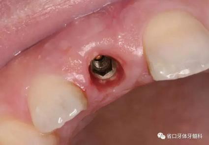 右上前牙即刻種植即刻修復(fù)1例 右上前牙即刻種植即刻修復(fù)1例