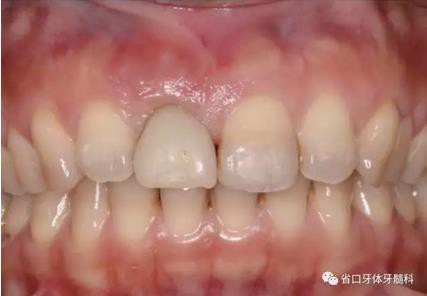 右上前牙即刻種植即刻修復(fù)1例 右上前牙即刻種植即刻修復(fù)1例