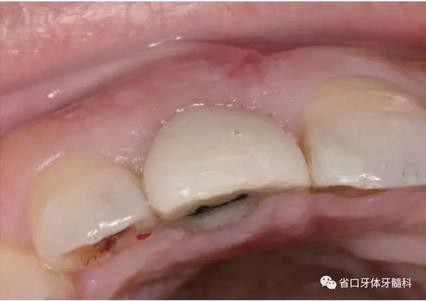 右上前牙即刻種植即刻修復(fù)1例 右上前牙即刻種植即刻修復(fù)1例