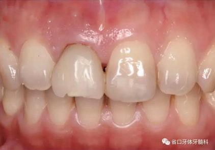 右上前牙即刻種植即刻修復(fù)1例 右上前牙即刻種植即刻修復(fù)1例