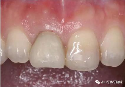 右上前牙即刻種植即刻修復(fù)1例 右上前牙即刻種植即刻修復(fù)1例