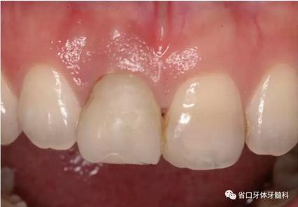 右上前牙即刻種植即刻修復(fù)1例 右上前牙即刻種植即刻修復(fù)1例