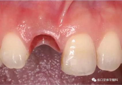 右上前牙即刻種植即刻修復(fù)1例 右上前牙即刻種植即刻修復(fù)1例