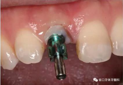 右上前牙即刻種植即刻修復(fù)1例 右上前牙即刻種植即刻修復(fù)1例