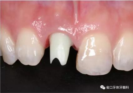 右上前牙即刻種植即刻修復(fù)1例 右上前牙即刻種植即刻修復(fù)1例