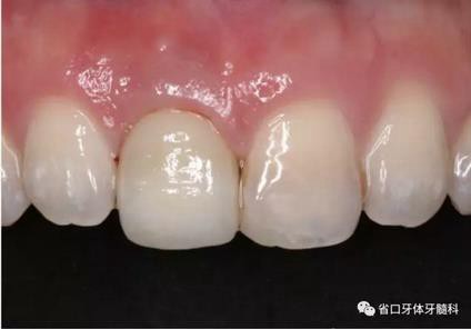 右上前牙即刻種植即刻修復(fù)1例 右上前牙即刻種植即刻修復(fù)1例