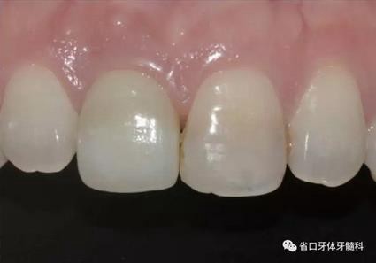 右上前牙即刻種植即刻修復(fù)1例 右上前牙即刻種植即刻修復(fù)1例