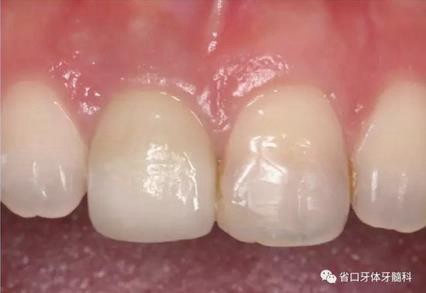 右上前牙即刻種植即刻修復(fù)1例 右上前牙即刻種植即刻修復(fù)1例