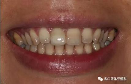 右上前牙即刻種植即刻修復(fù)1例 右上前牙即刻種植即刻修復(fù)1例