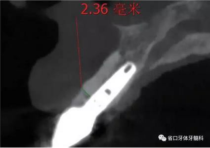 右上前牙即刻種植即刻修復(fù)1例 右上前牙即刻種植即刻修復(fù)1例