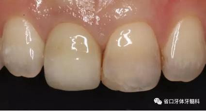 右上前牙即刻種植即刻修復(fù)1例 右上前牙即刻種植即刻修復(fù)1例