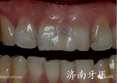 四環(huán)素牙修復(fù)真實(shí)操作.png 四環(huán)素牙修復(fù)真實(shí)操作.png