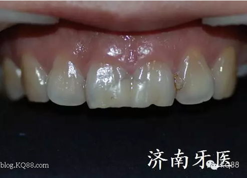 四環(huán)素牙修復(fù)真實(shí)操作.png 四環(huán)素牙修復(fù)真實(shí)操作.png