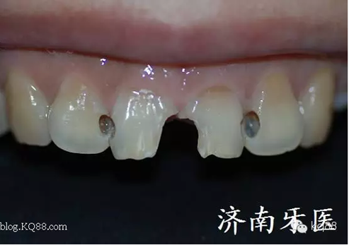 四環(huán)素牙修復(fù)真實(shí)操作.png 四環(huán)素牙修復(fù)真實(shí)操作.png