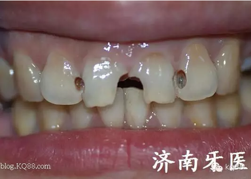 四環(huán)素牙修復(fù)真實(shí)操作.png 四環(huán)素牙修復(fù)真實(shí)操作.png