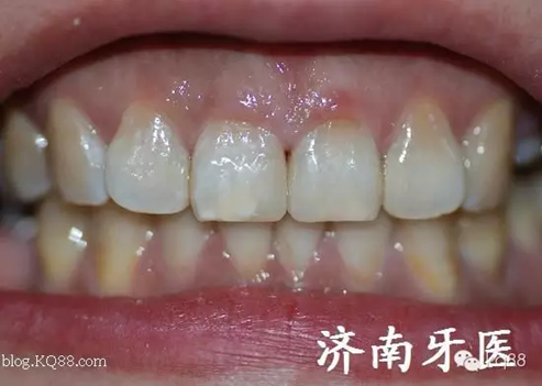 四環(huán)素牙修復(fù)真實(shí)操作.png 四環(huán)素牙修復(fù)真實(shí)操作.png