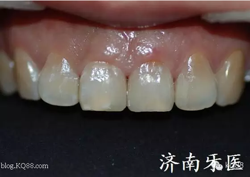 四環(huán)素牙修復(fù)真實(shí)操作.png 四環(huán)素牙修復(fù)真實(shí)操作.png