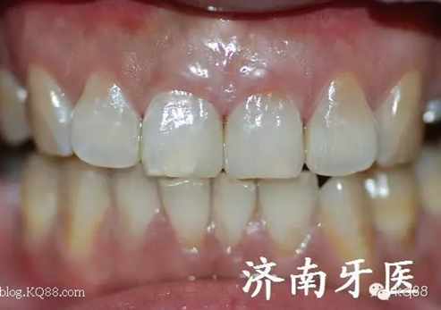 四環(huán)素牙修復(fù)真實(shí)操作.png 四環(huán)素牙修復(fù)真實(shí)操作.png