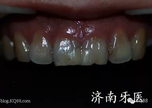 四環(huán)素牙修復(fù)真實(shí)操作.png 四環(huán)素牙修復(fù)真實(shí)操作.png