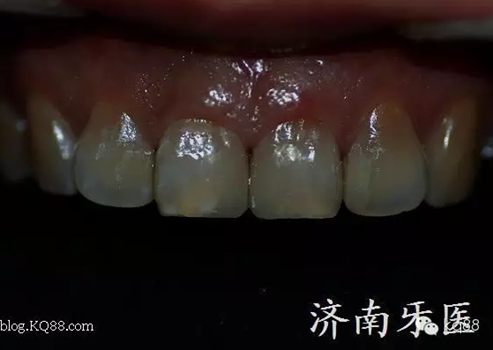 四環(huán)素牙修復(fù)真實(shí)操作.png 四環(huán)素牙修復(fù)真實(shí)操作.png