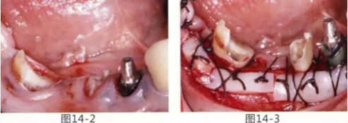 FGG法增大附著齦及根面覆蓋【牙齦-牙槽黏膜的問題】.png FGG法增大附著齦及根面覆蓋【牙齦-牙槽黏膜的問題】.png
